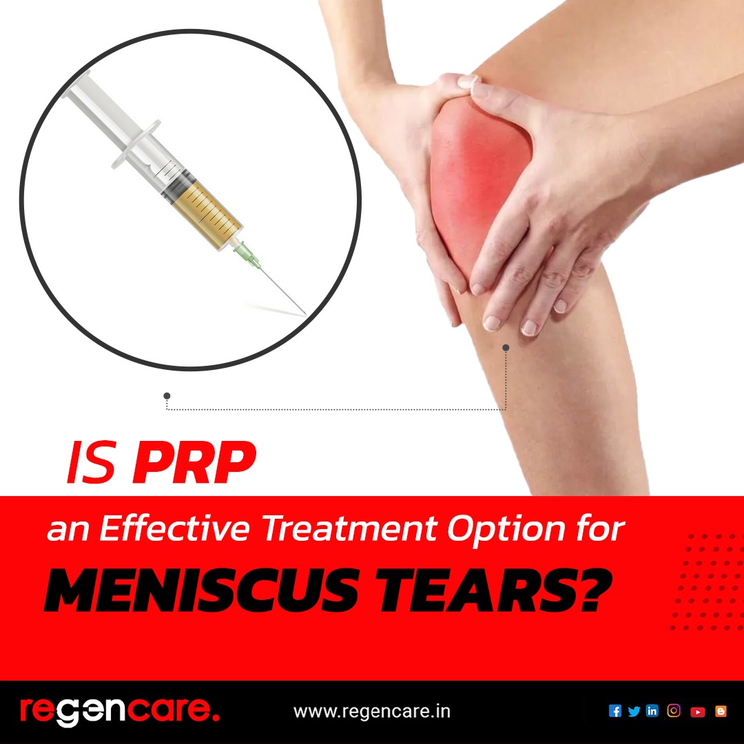 Is PRP an effective treatment option for meniscus tears? - Regencare, Kochi