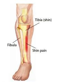 Shin Splints Bone Look SHIN SPLINTS - Regencare